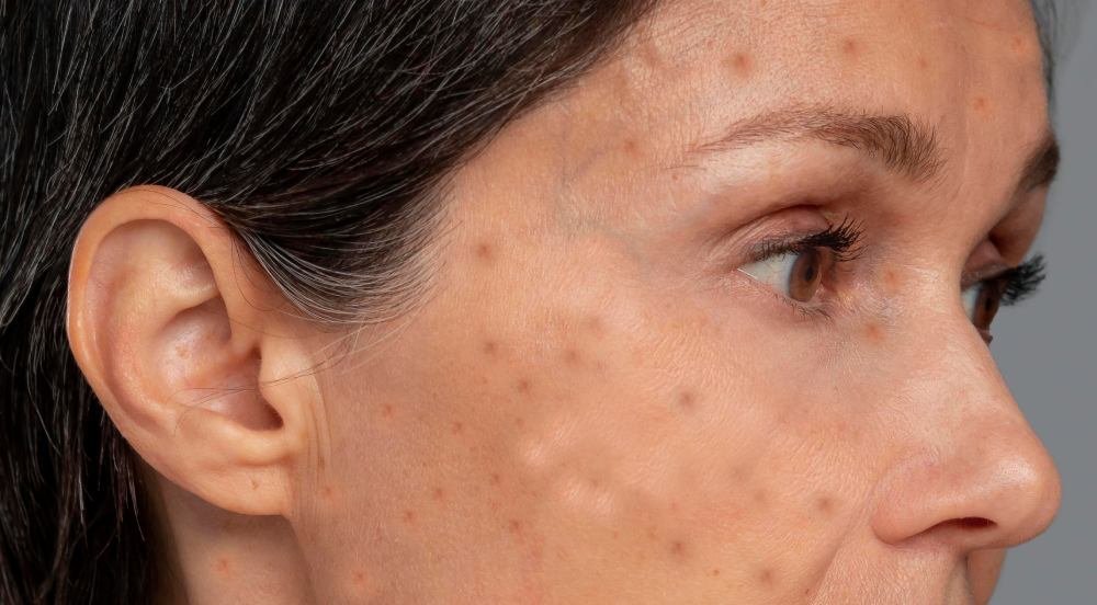 Before Treatment